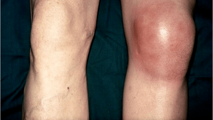 Arthrosis an Arthritis